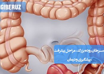 سرطان روده بزرگ: مراحل پیشرفت، راههای پیشگیری و درمان، اطلاعات جامع و حیاتی برای سلامت