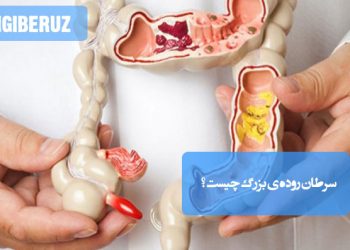 سرطان روده بزرگ: تعریف و اطلاعات حیاتی درباره این بیماری، برای آگاهی و پیشگیری