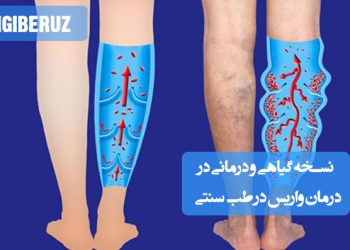 درمان واریس با نسخه‌های گیاهی و روش‌های طبیعی تقویت رگ‌ها و بهبود گردش خون در طب سنتی