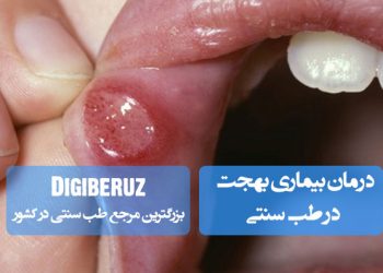 درمان بیماری بهجت در طب سنتی با استفاده از داروهای گیاهی و روشهای تقویتی برای کاهش التهاب و علائم