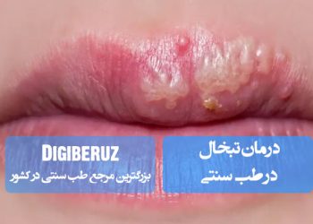 درمان تبخال در طب سنتی با استفاده از گیاهان دارویی و روش‌های طبیعی برای کاهش التهاب و تسریع بهبود