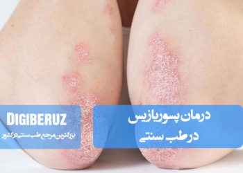 درمان پسوریازیس در طب سنتی با استفاده از گیاهان دارویی، تنظیم مزاج و روش‌های طبیعی کاهش التهاب پوست