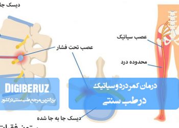 درمان کمر درد و سیاتیک با روشهای طب سنتی شامل ماساژ، داروهای گیاهی و اصلاح سبک زندگی