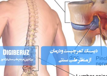 دیسک کمر چیست و درمان آن در طب سنتی با استفاده از داروهای گیاهی، ماساژ و اصلاح سبک زندگی