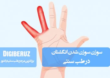 علل و درمان سوزن‌سوزن شدن انگشتان با روش‌های طب سنتی شامل گیاهان دارویی و اصلاح مزاج
