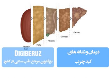 درمان و نشانه های کبد چرب قسمت دوم