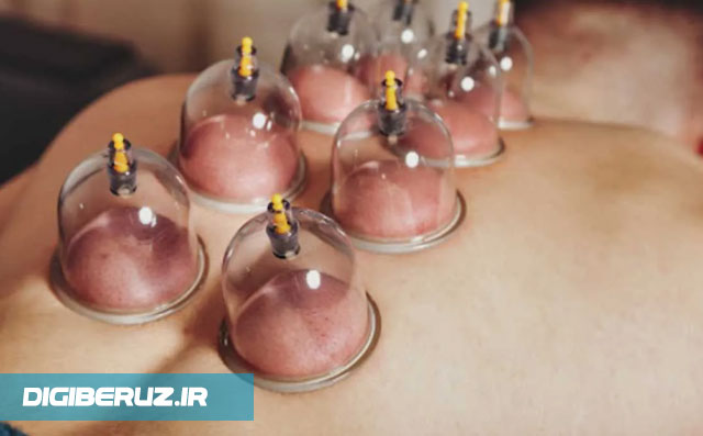 چه موقع به حجامت نیاز داریم